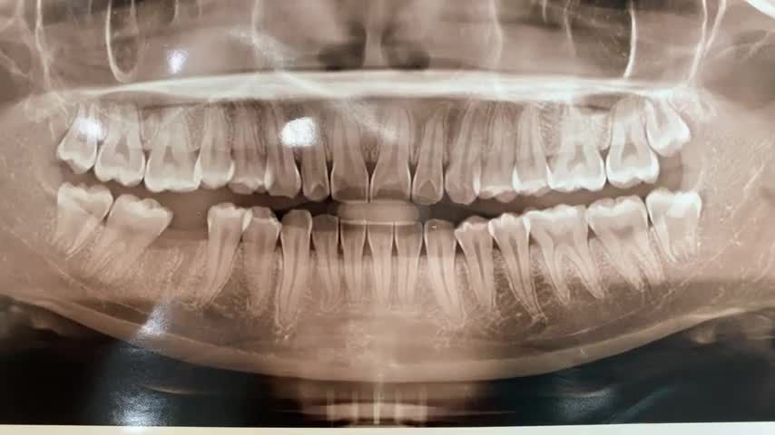 Ca gắn răng sứ trên chân Implant cho khách hàng tại Nha Khoa Thuỳ Anh.