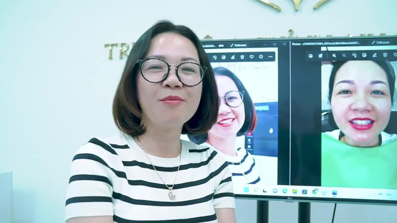 CA PHỐI MÀU ĐỈNH CAO XỬ LÝ RĂNG NHIỄM TETACYLINE NẶNG