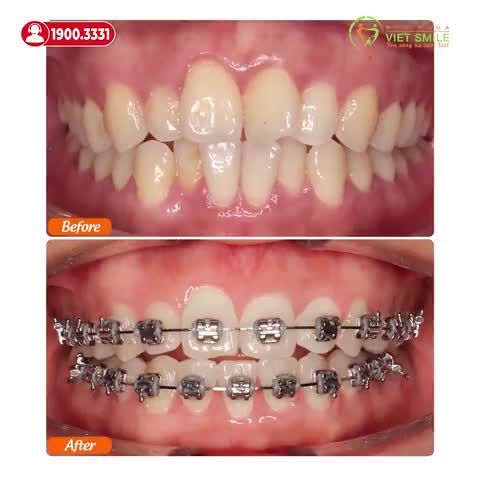 CẢM NHẬN SAU 6 THÁNG NIỀNG RĂNG KHẤP KHỂNH