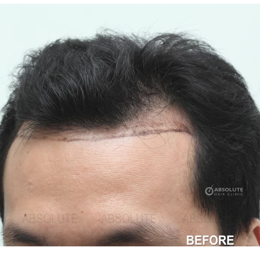 Kết quả sau cấy tóc tự thân của khách hàng