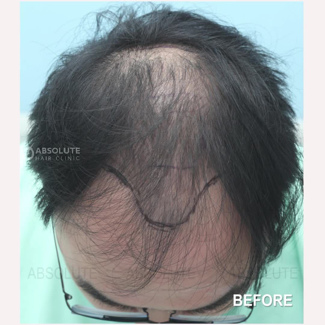 Hiệu quả sau cấy tóc tự thân tại Absolute Hair Clinic