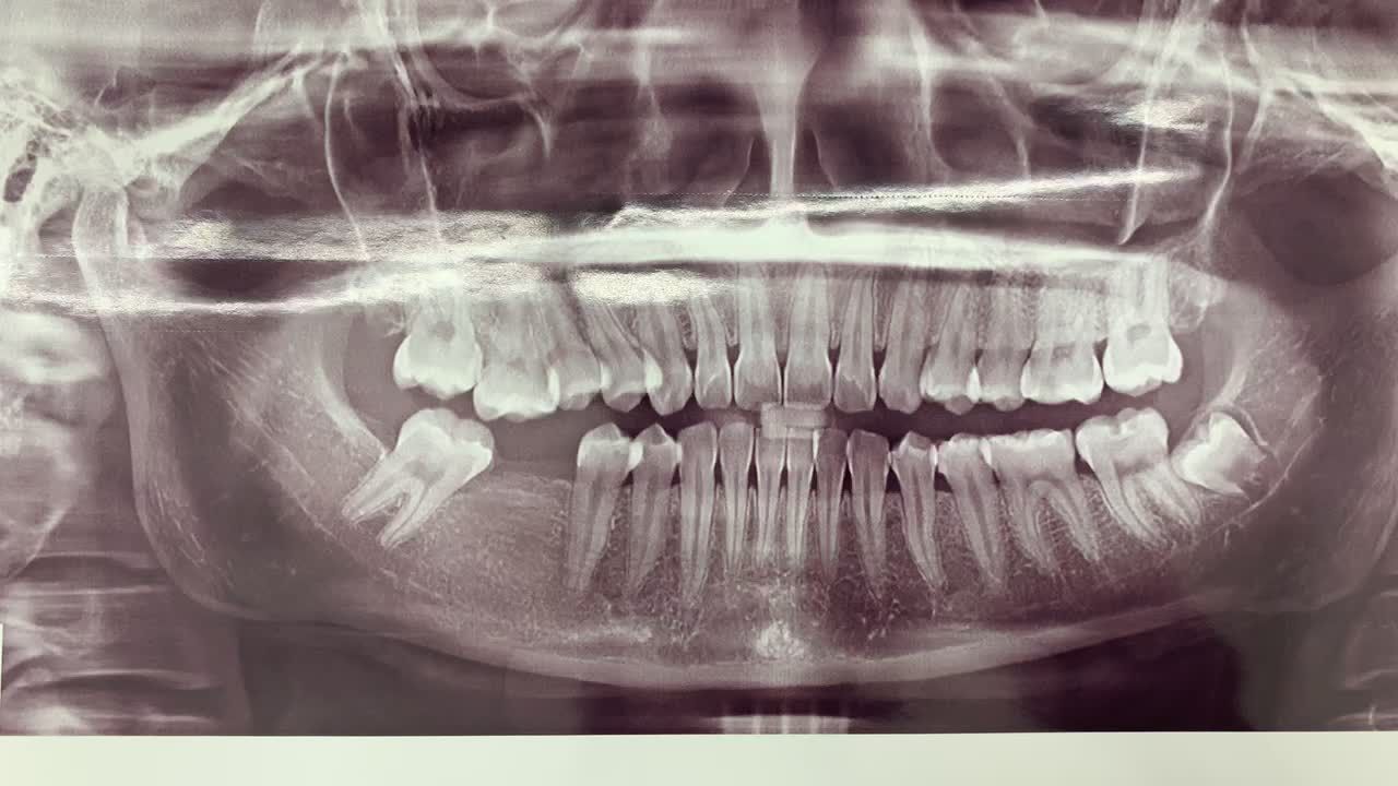 Cấy chân răng nhân tạo Implant khôi phục lại răng 46 bị mất cho bạn Nguyệt.