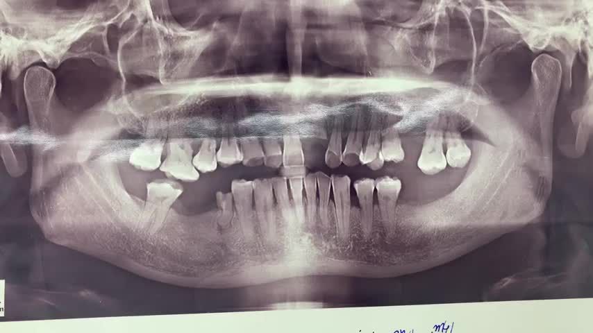 Cấy chân răng nhân tạo khôi phục răng 26 bị mất cho bác khách hàng tại Nha Khoa Thuỳ Anh.