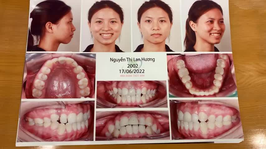 Cấy minivis tạo khoảng trống kéo răng ngầm cho bạn Lan Hương tại Nha Khoa Thuỳ Anh