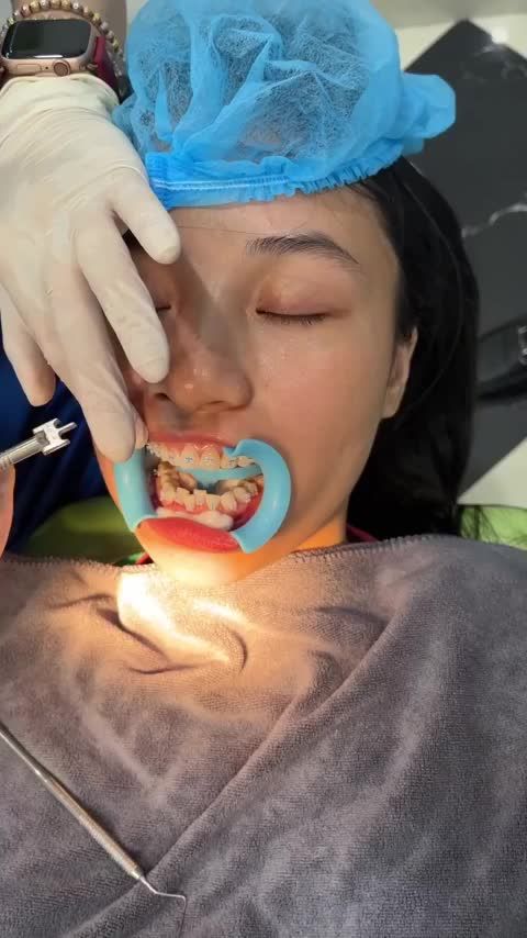 GẮN CỐ ĐỊNH MẮC CÀI NIỀNG RĂNG CHO NỮ KHÁCH HÀNG