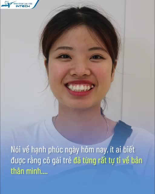 HÀNH TRÌNH NIỀNG RĂNG VÀ CÁI KẾT VIÊN MÃN CỦA CẶP ĐÔI 9X