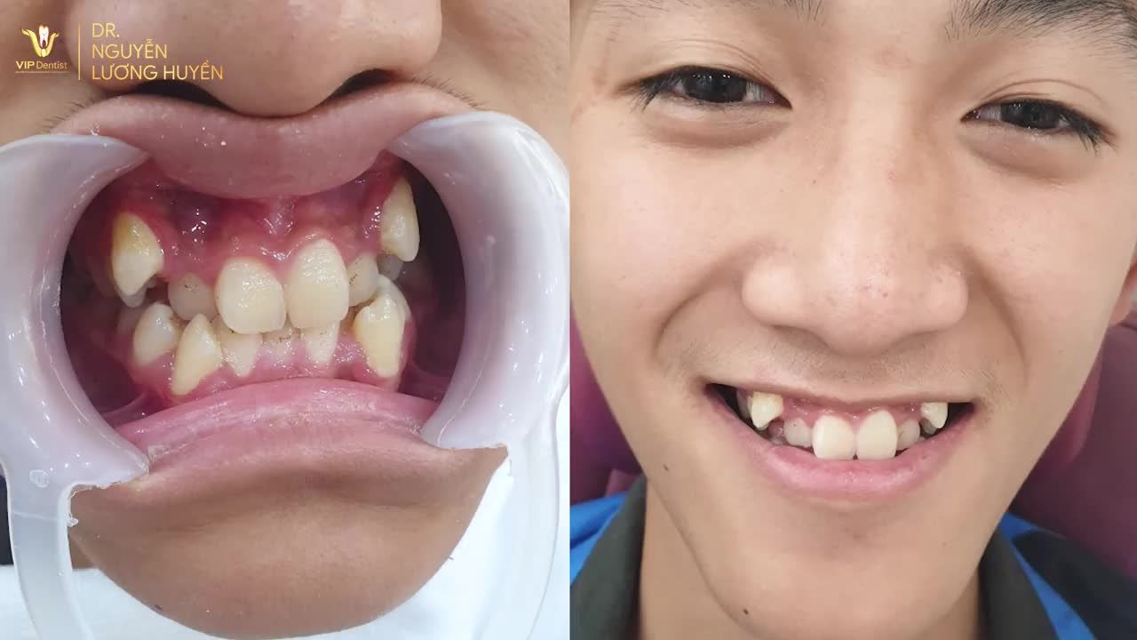 Hành trình thay đổi nụ cười tuy cần nhiều thời gian và kiên trì nhưng quả ngọt chính là ngoại hình cực phẩm chuẩn lãng tử mà Tấn Phong sở hữu hiện tại.
