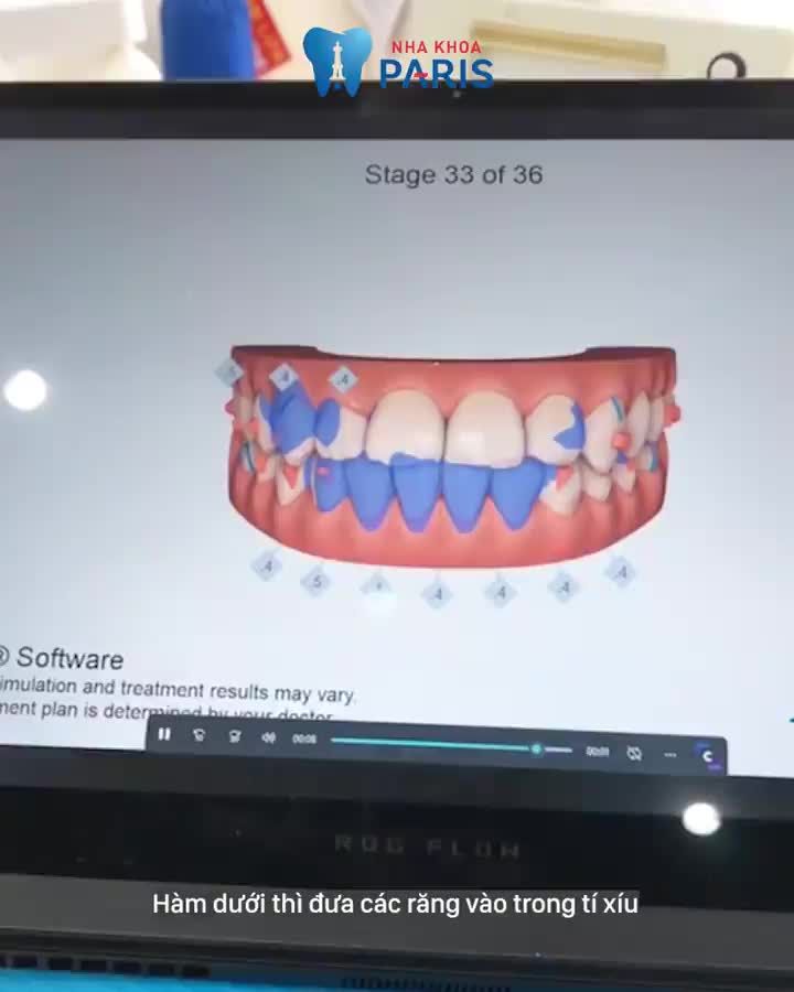 Invisalign - Không đau khi niềng răng