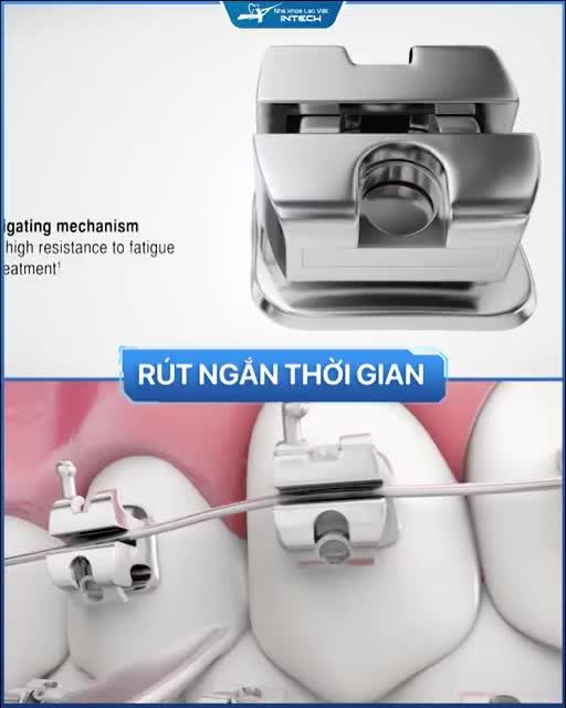Kết hợp công nghệ X-Matrix giúp niềng răng dễ dàng, giảm đau tới 60%