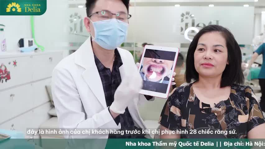 Khách hàng Trần Thị Huệ (Việt Kiều Séc) gặp phải tình trạng Sai khớp cắn, mòn rìa cắn, từng làm sứ mơi khác sai kỹ thuật