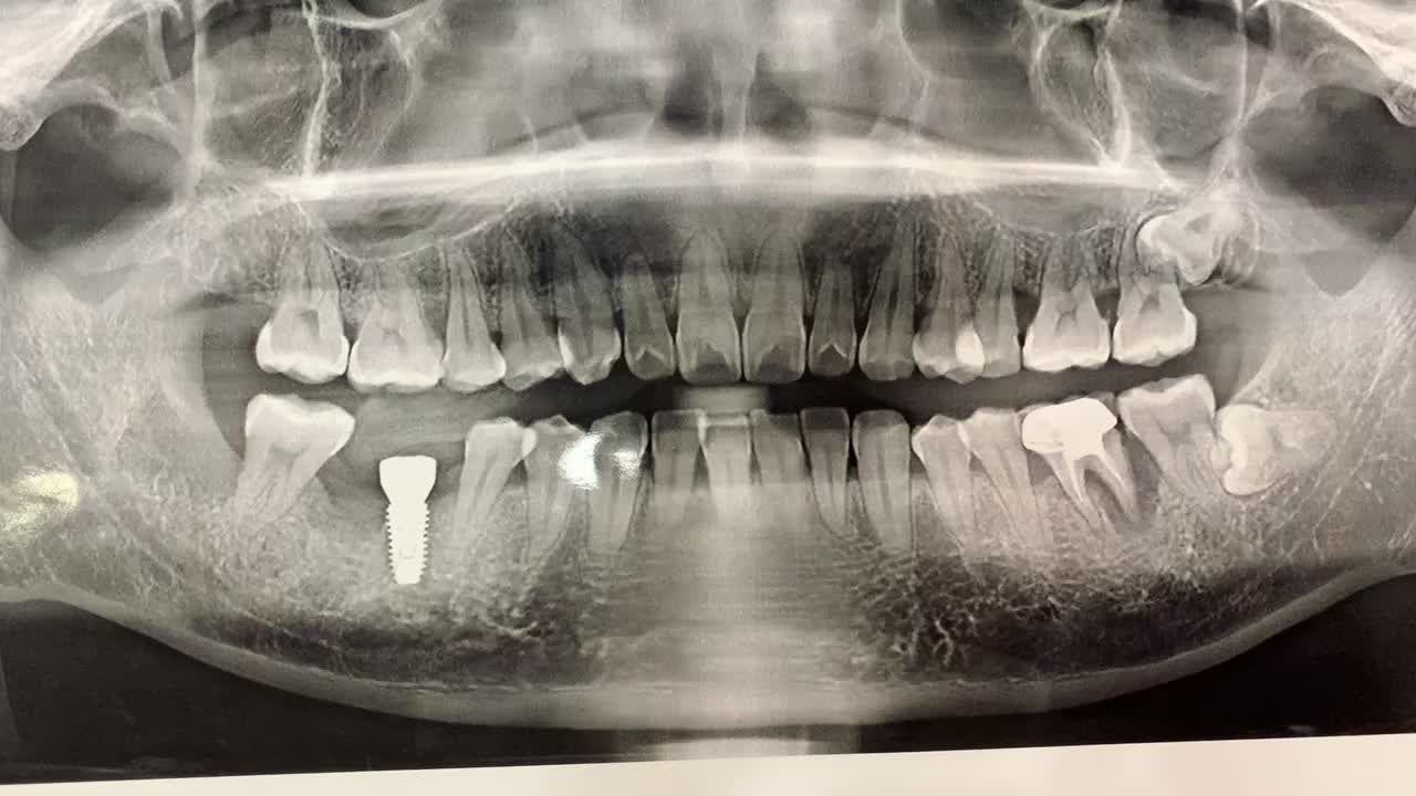 Lắp răng implant cho khách hàng tại nha khoa Thùy Anh.