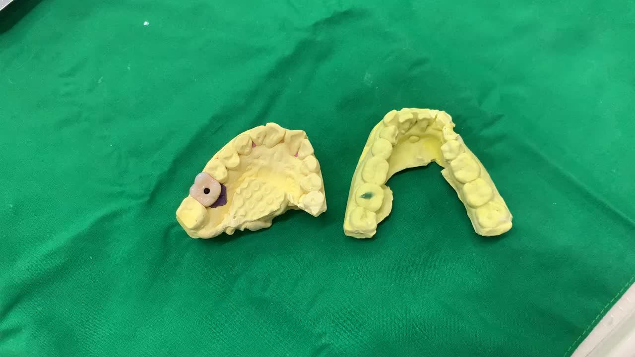 Lắp răng Implant khôi phục răng 16 bị mất cho bác Nhuận.