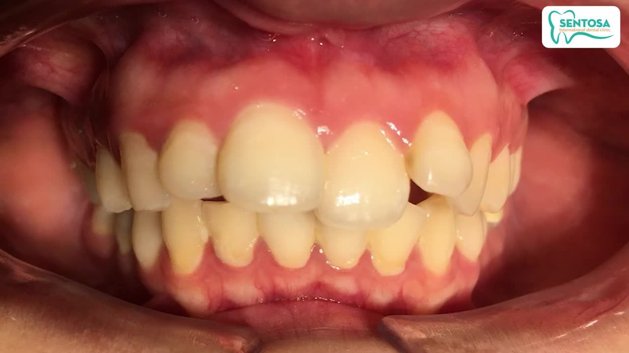 LẤY LẠI NỤ CƯỜI TƯƠI NHỜ CHỈNH NHA MẮC CÀI