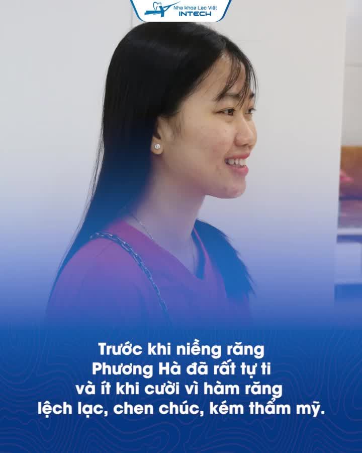 “LỘT XÁC VI DIỆU” NHỜ NIỀNG RĂNG