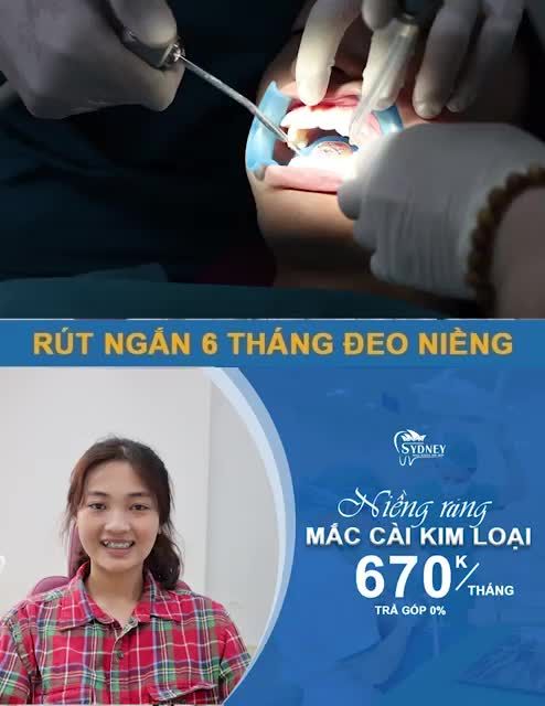 Mắc cài kim loại giúp tăng hiệu quả niềng răng như thế nào