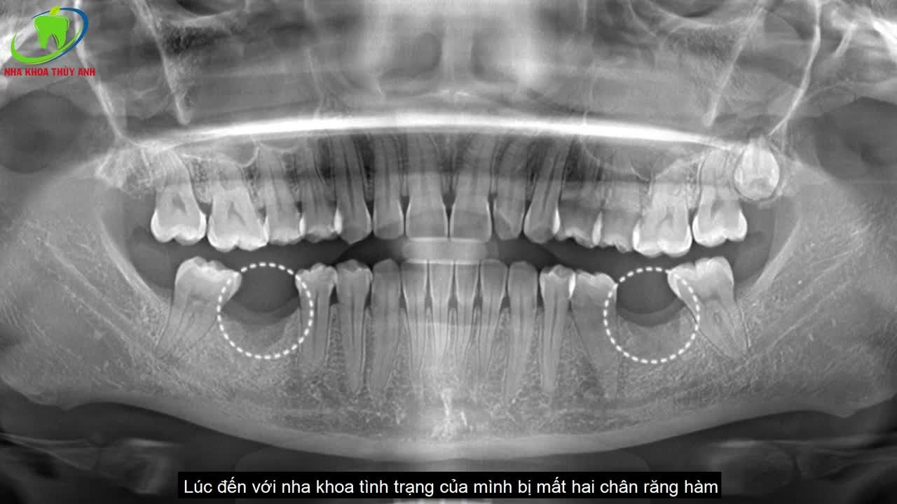 MẤT RĂNG CHỌN NGAY TRỒNG RĂNG IMPLANT