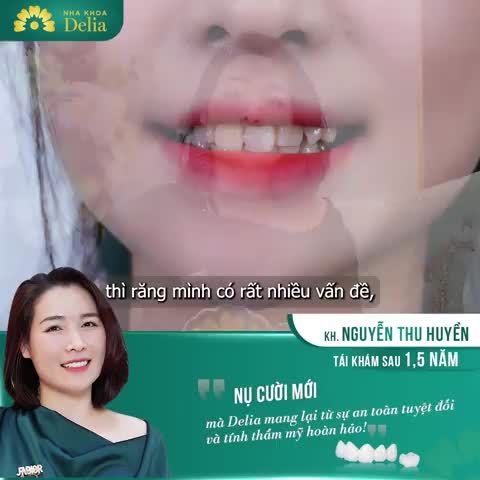 Mình đã tự tin hơn rất nhiều sau khi làm răng, nụ cười rạng rỡ đã được tìm lại tại Delia.