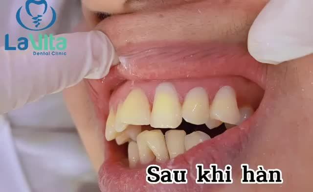 MÒN CỔ RĂNG LÀ GÌ CÓ NGUY HIỂM KHÔNG