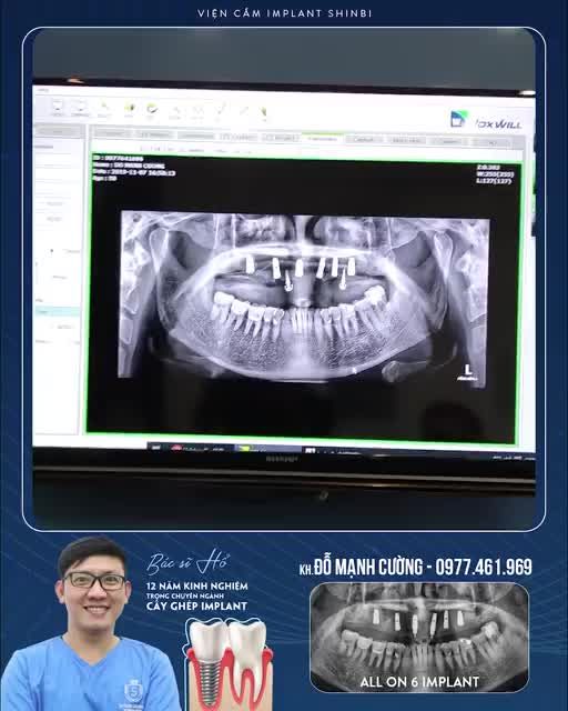 NẾU BẠN HAY NGƯỜI THÂN BỊ MẤT RĂNG ĐÂY LÀ 1 VIDEO BẠN NÊN XEM VÌ…