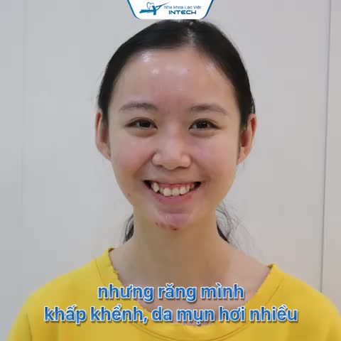 NIỀNG RĂNG – QUYẾT ĐỊNH SÁNG SUỐT NHẤT CUỘC ĐỜI TÔI…