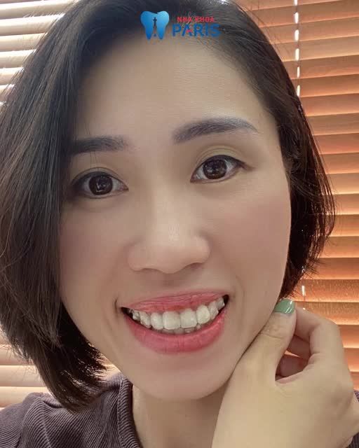 Niềng răng trong suốt khách hàng sốc vì quá đẹp
