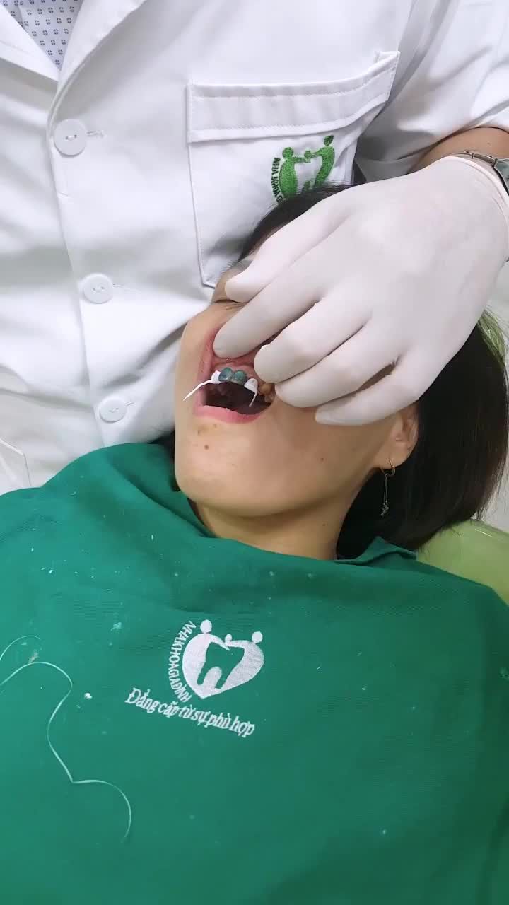 QUÁ TRÌNH GẮN VENEER SỨ CHO MỘT VỊ NỮ KHÁCH HÀNG