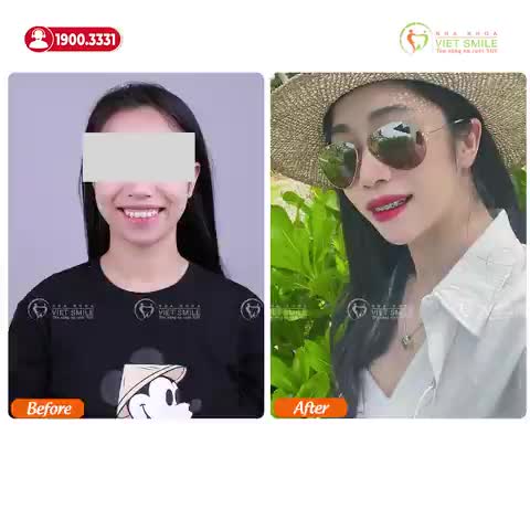 SAU 10 THÁNG NIỀNG RĂNG HÔ, CƯỜI HỞ LỢI