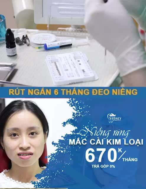 TẠI SAO NIỀNG RĂNG MẮC CÀI KIM LOẠI VẪN ĐƯỢC ƯA CHUỘNG