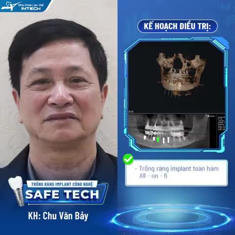 TRẢI NGHIỆM TRỒNG RĂNG IMPLANT TẠI LẠC VIỆT INTECH NHƯ THẾ NÀO