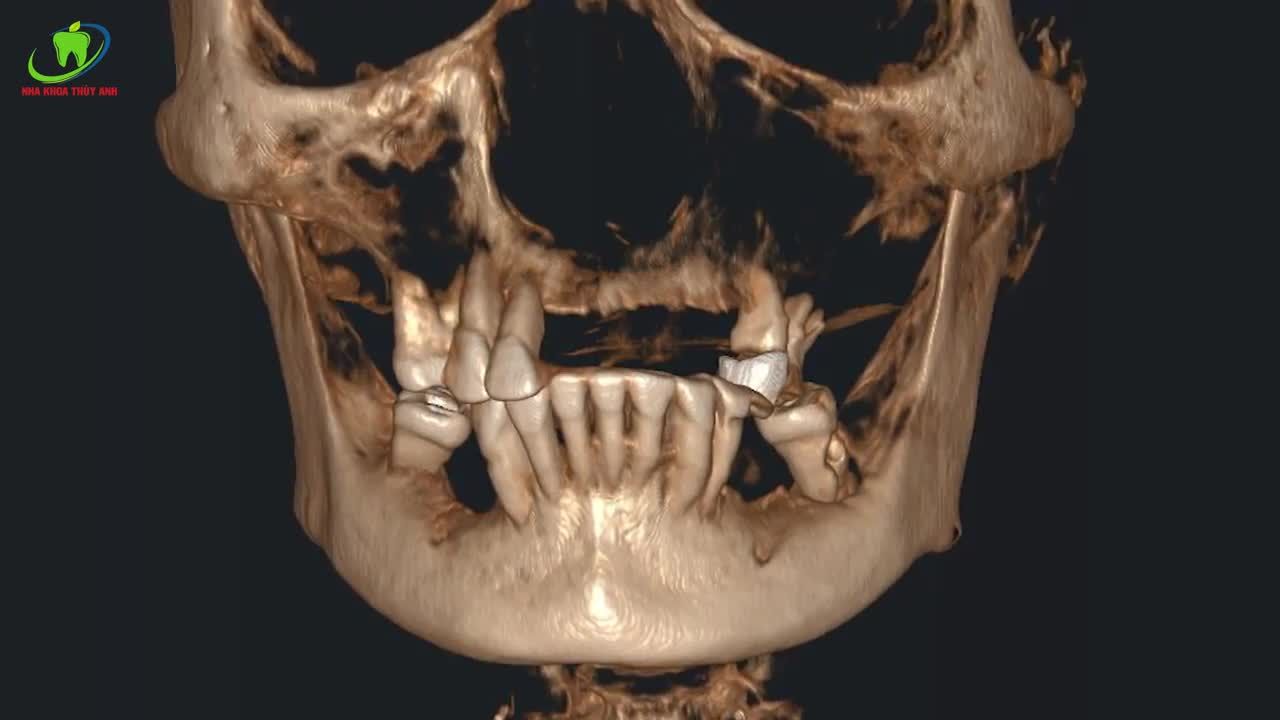 TRẺ HƠN, KHOẺ HƠN NHỜ TRỒNG RĂNG IMPLANT ALL ON 4