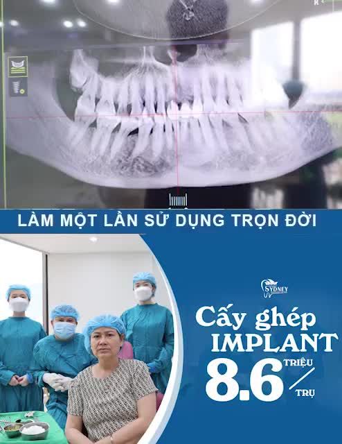 TRỒNG RĂNG IMPLANT BAO LÂU THÌ LÀNH