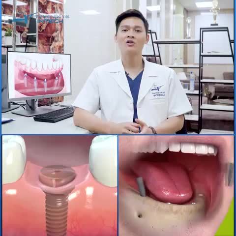 Trồng răng implant đơn lẻ và trồng răng implant toàn hàm đều là phương pháp phục hình răng đã mất bằng trụ implant nhằm khôi phục chức năng thẩm mỹ và chức năng ăn nhai cho khách hàng.