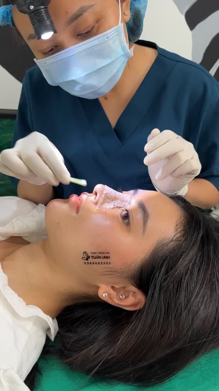 Cận cảnh dáng mũi sau 10 ngày nâng cấu trúc