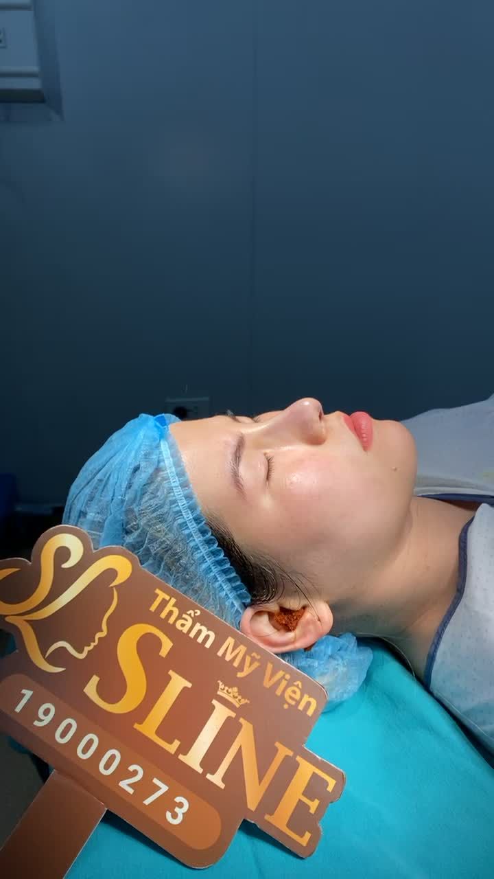 KẾT QUẢ NÂNG MŨI