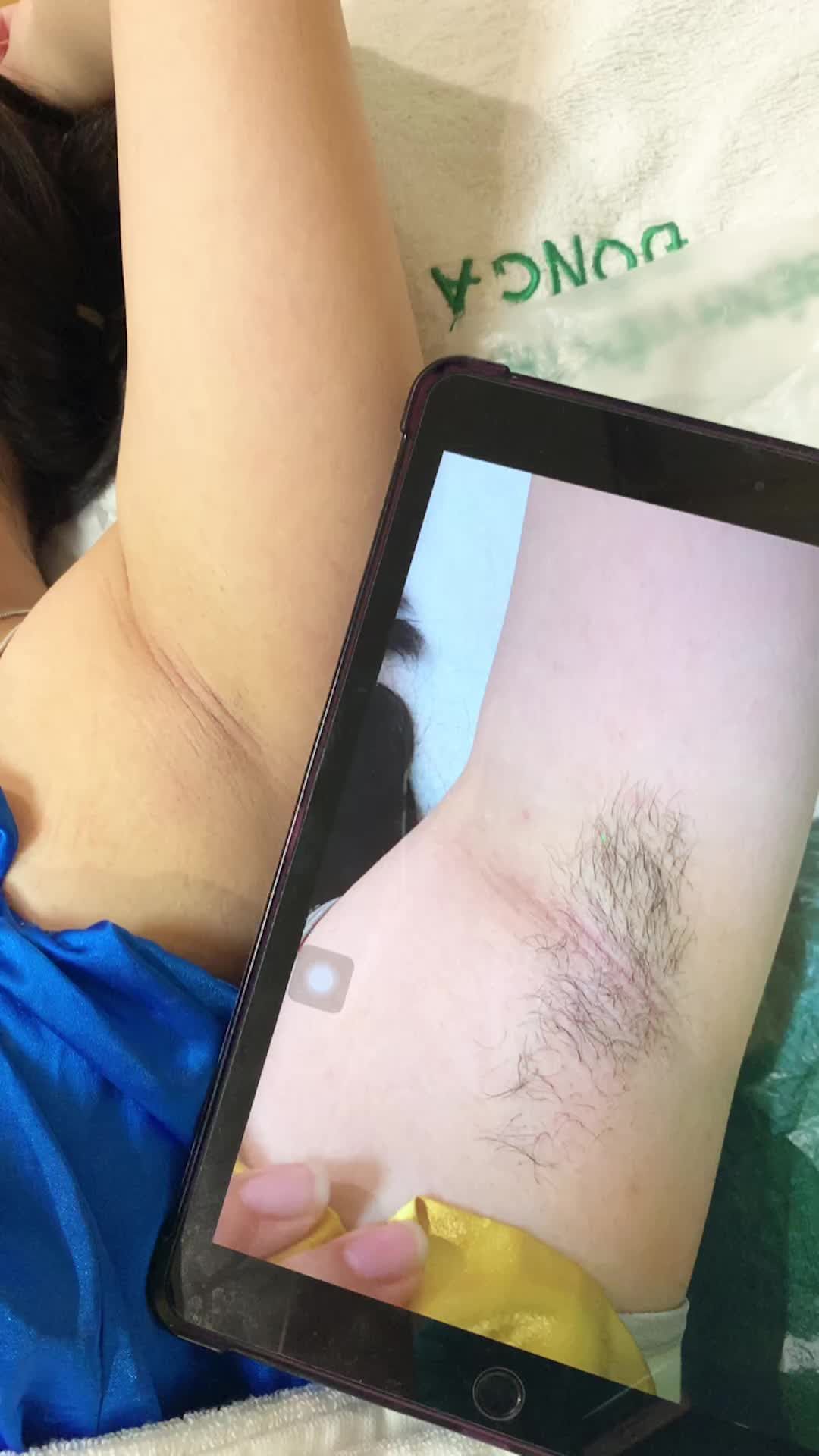 Triệt lông siêu hiệu quả rút ngắn thời gian điều trị cho khách hàng chỉ có thể là công nghệ Ice Dior Laser của Đông Á