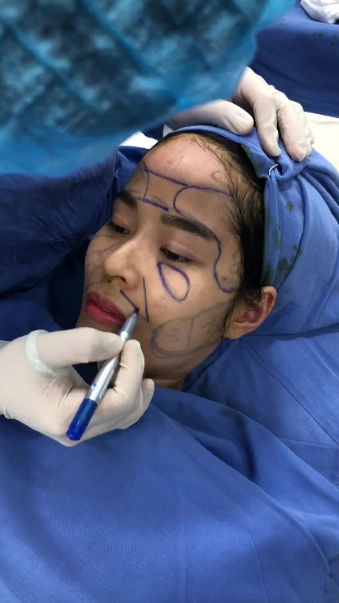 Live bác sĩ phân tích khách hàng với khuyết điểm Thái dương lõm, má hópBác sĩ tư vấn phương pháp cấy mỡ tự thân giúp đầy đặn, trẻ hóa gương mặt