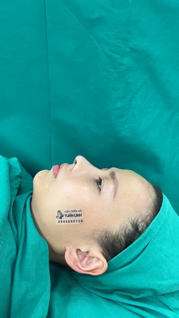 Mũi bị lệch sau 5 năm nâng tại cơ sở khác... chọn Tuấn Linh để sửa lại và cái kết