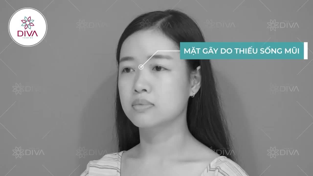 SAU 30 PHÚT NÂNG MŨI KHẮC PHỤC TÌNH TRẠNG MŨI THẤP, GÃY TRŨNG