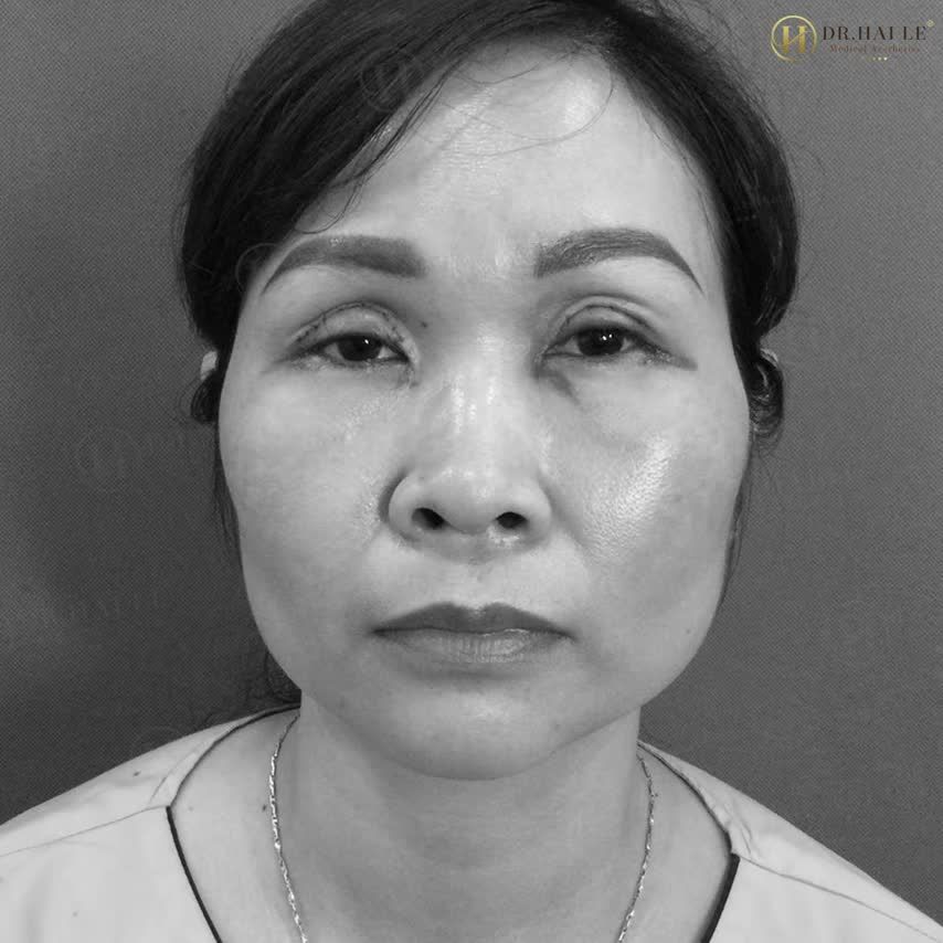 Trót cắt mí lỗi, hỏng. ĐÂU LÀ GIẢI PHÁP
