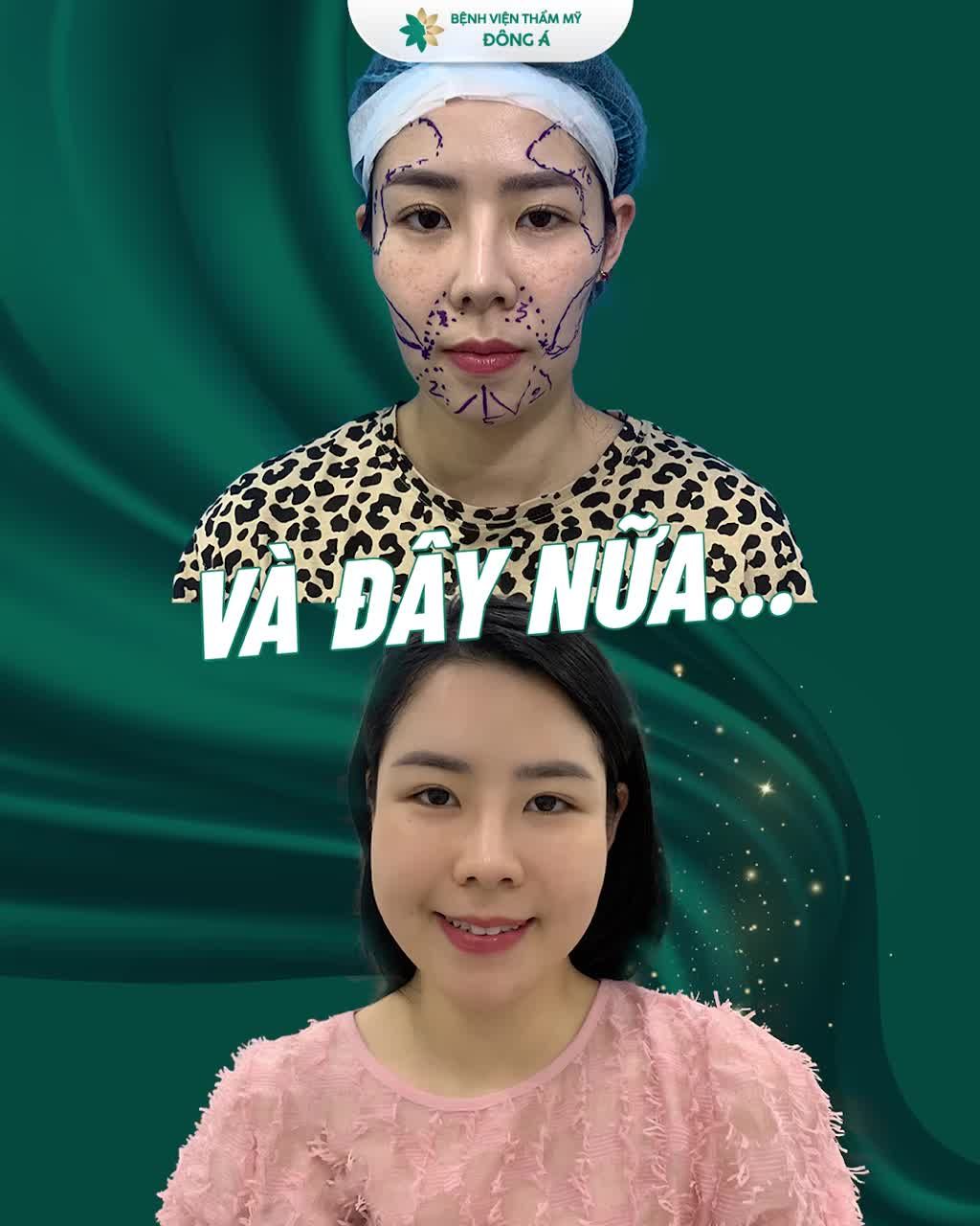 Bóc trần sự thật CẤY MỠ MẶT TỰ THÂN
