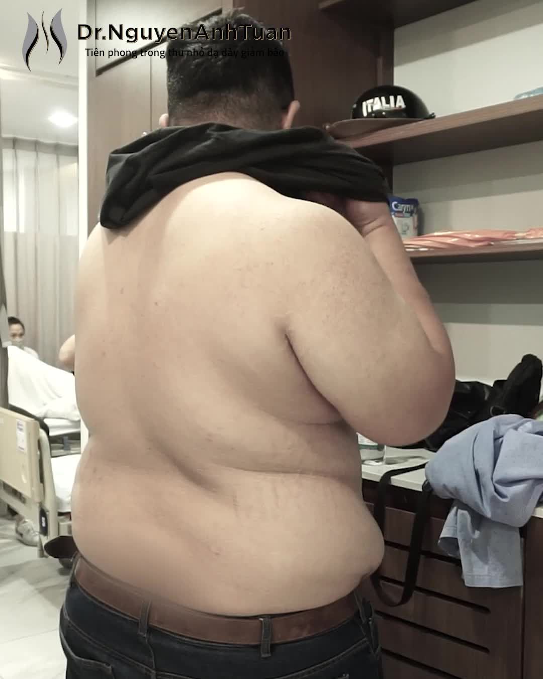 Chưa từng có Phẫu thuật thu nhỏ dạ dày cho bệnh nhân 21 tuổi có cân nặng và BMI khủng