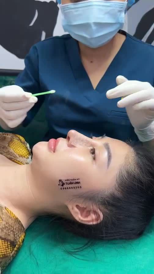 Dáng mũi cao tây đẹp chuẩn tỉ lệ vàng sau 10 ngày tháo nẹp