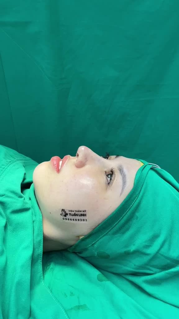 Nâng mũi cấu trúc sụn sugrifom lên dáng cao tây đẹp xuất sắc sau 90 phút!!!