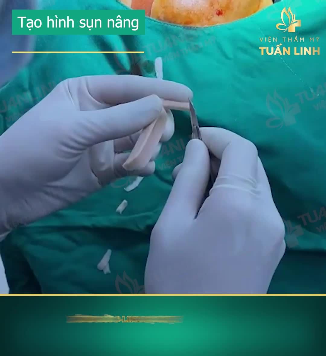 NÂNG MŨI SLINE BỌC SỤN TAI 12TR - TRẢ GÓP LÃI 0%