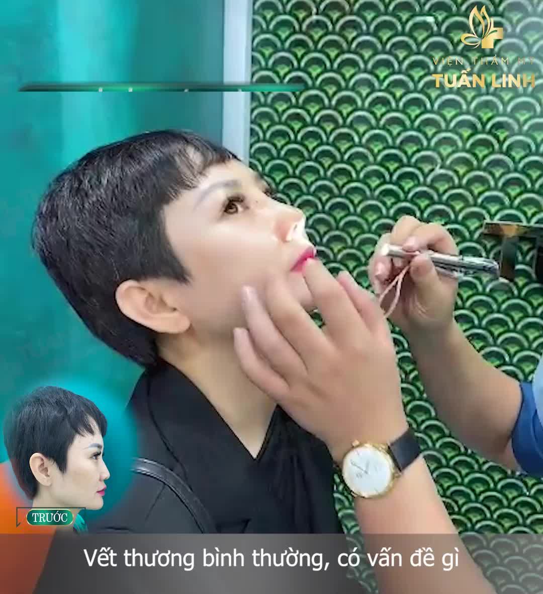 Chia sẻ của khách hàng sau 14 ngày nâng mũi bán cấu trúc tại Tuấn Linh