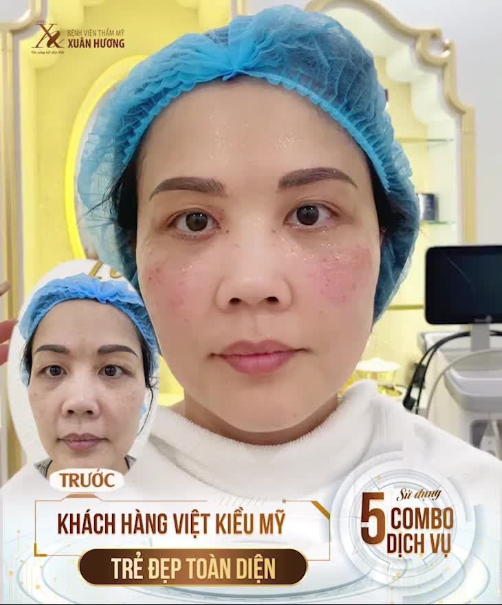 KHÁCH HÀNG VIỆT KIỀU MỸ TRẺ ĐẸP TOÀN DIỆN VỚI COMBO DỊCH VỤ TẠI XUÂN HƯƠNG