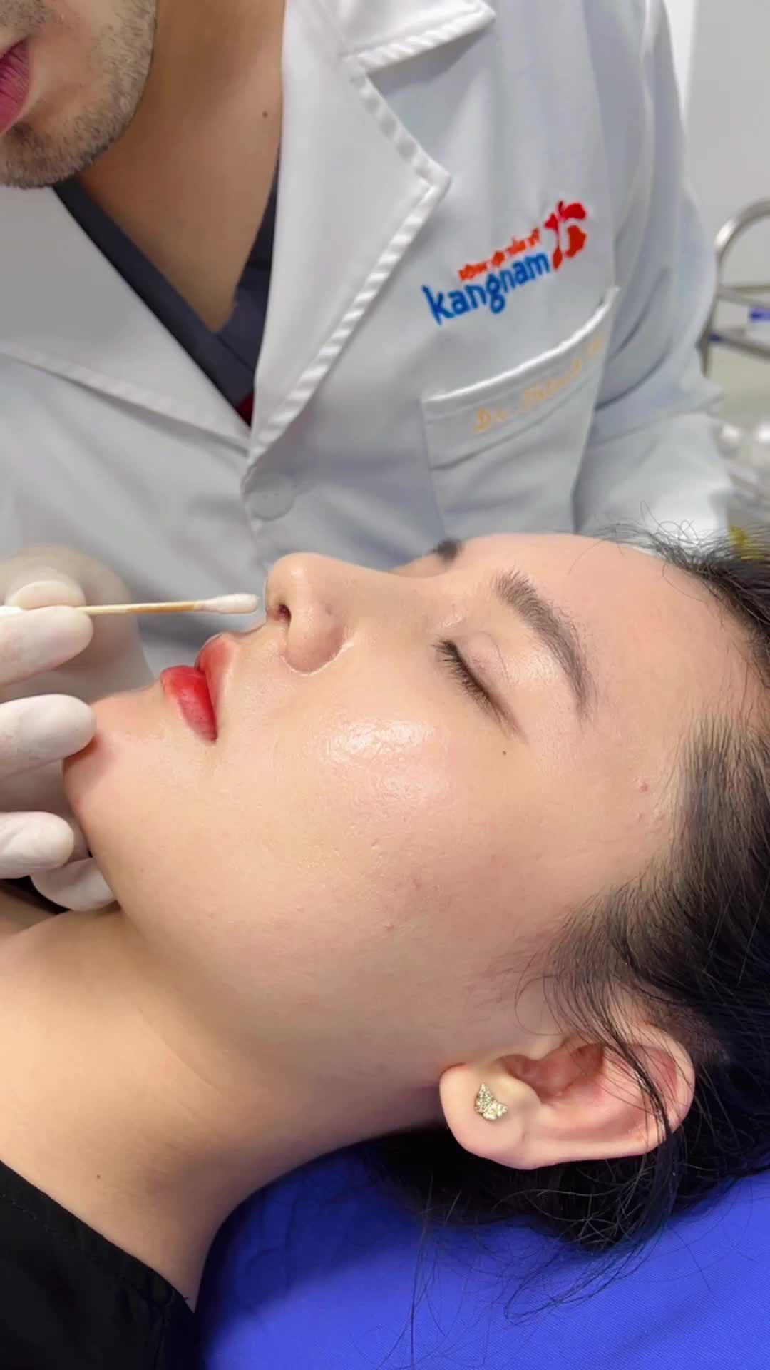 Quá trình cắt chỉ Mũi Cấu trúc 6D Chất liệu Surgi Form Không đau tại Kangnam