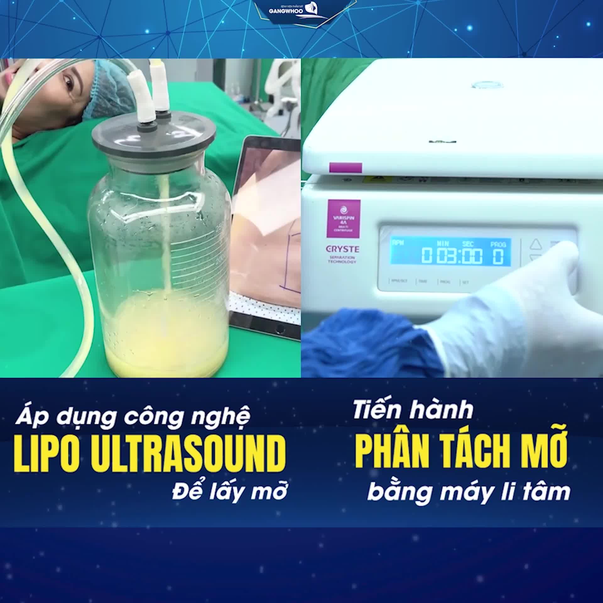 CẤY MỠ TỰ THÂN – TRẺ HÓA TOÀN DIỆN,  HIỆU QUẢ NHÂN ĐÔI