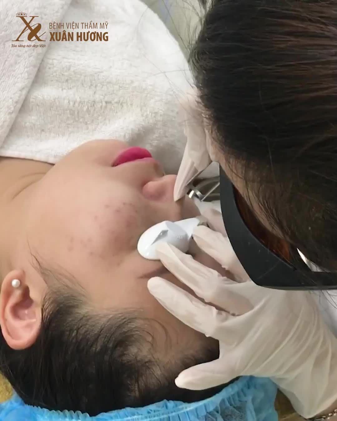 CHỈ CẦN 1 LẦN GIẢI QUYẾT DỨT ĐIỂM TÀN NHANG VÀ MỰC XĂM MÍ MẮT