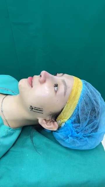 Kết quả nâng mũi siêu đẹp cho cô bé Streamer xinh gái nhà Tuấn Linh